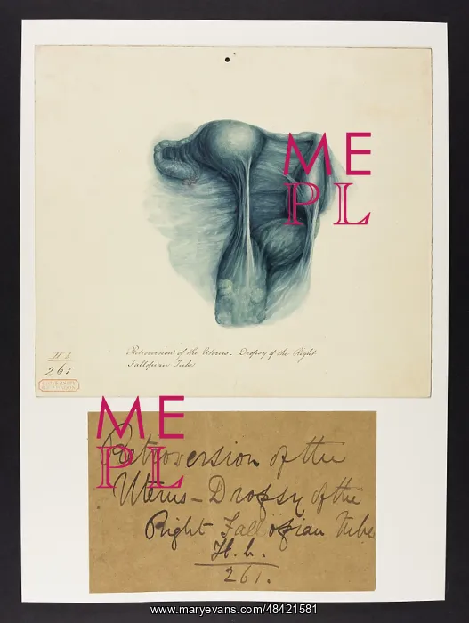 : Retroversion of Uterus: Dropsy of Fallopian Tube : Retroversion of Uterus: Dropsy of Fallopian Tube