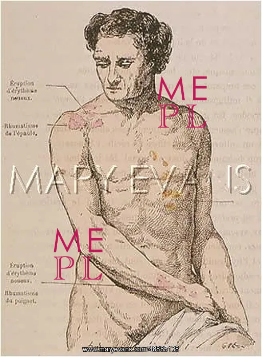 : RHEUMATISM / 1883 : RHEUMATISM / 1883