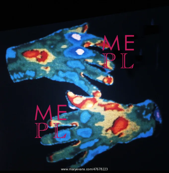 : Rheumatoid Arthritis, Hands, Early Thermogram : Rheumatoid Arthritis, Hands, Early Thermogram
