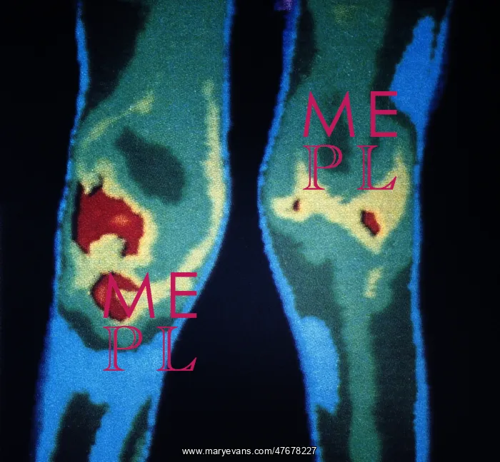 : Rheumatoid Arthritis, Knees, Early Thermogram : Rheumatoid Arthritis, Knees, Early Thermogram