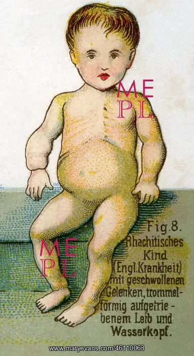 : Rickets, 1902 : Rickets, 1902