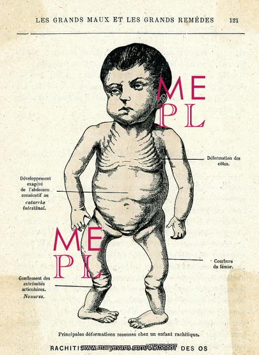  : RICKETS PATIENT