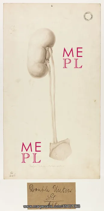 : Right Kidney with Two Ureters : Right Kidney with Two Ureters