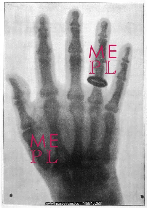  : Roentgen system x-ray