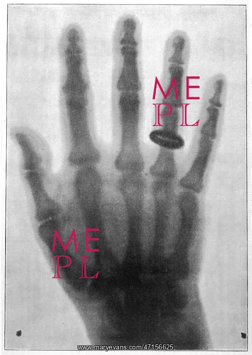 : Roentgen system x-ray : Roentgen system x-ray