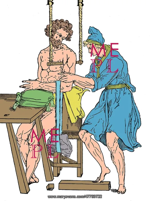 : Roman Devices for Setting Fractures : Roman Devices for Setting Fractures