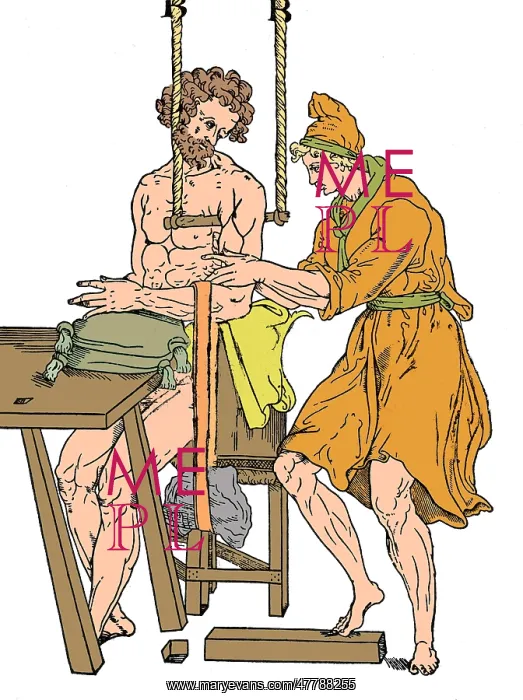 : Roman Devices for Setting Fractures : Roman Devices for Setting Fractures