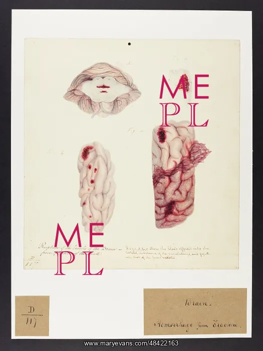 : Rupture of the Vessels of the Brain : Rupture of the Vessels of the Brain