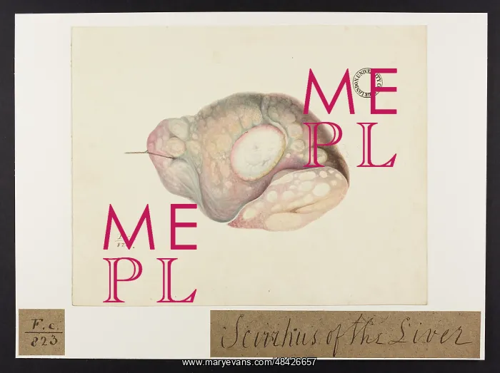 : Scirrhus of Liver : Scirrhus of Liver