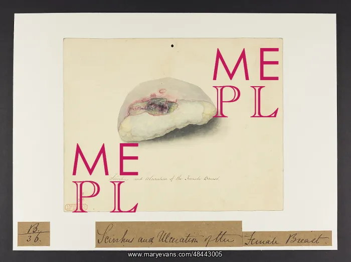 : Scirrhus & Ulceration of the Breast : Scirrhus & Ulceration of the Breast