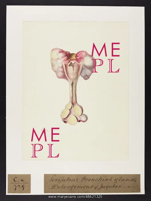 : Scrofulous Bronchial Glands : Scrofulous Bronchial Glands