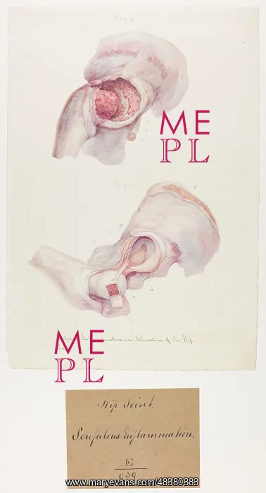 : Scrofulous Inflammation and Ulceration of Hip Joint : Scrofulous Inflammation and Ulceration of Hip Joint