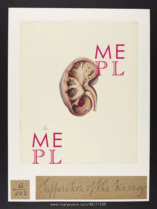 : Scrofulous Suppuration of the Kidney : Scrofulous Suppuration of the Kidney