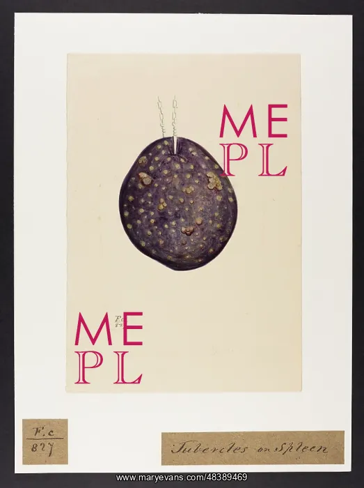: Scrofulous Tubercles of the Spleen : Scrofulous Tubercles of the Spleen