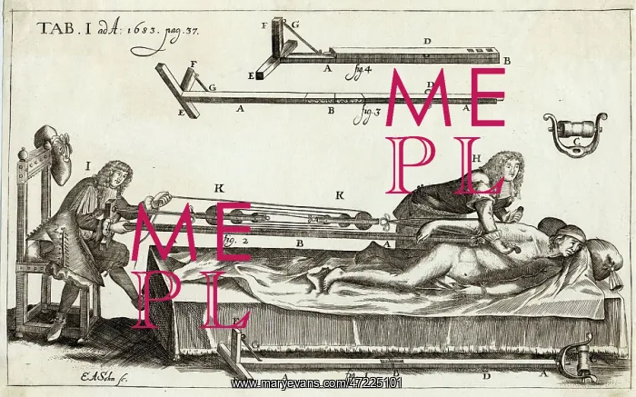 : SETTING A BONE 1682 : SETTING A BONE 1682