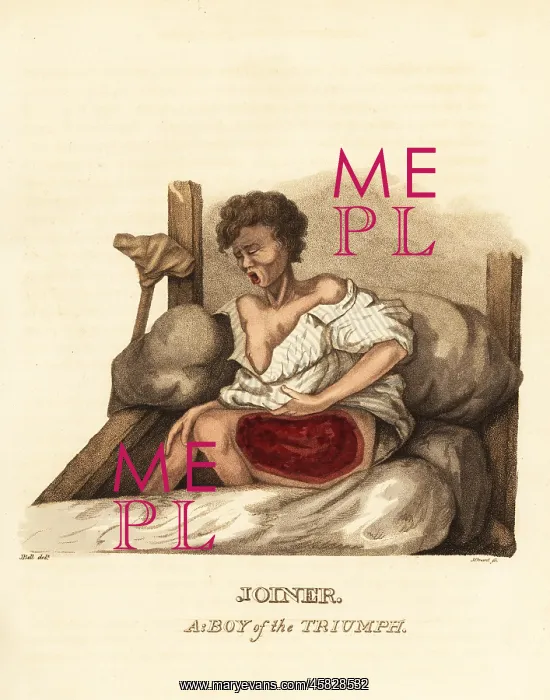 : A ship's boy with a case of necrotizing fasciitis : A ship's boy with a case of necrotizing fasciitis