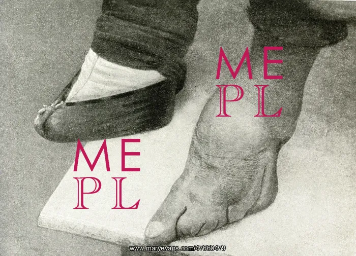 : Shocking result of binding girls feet, China, East Asia : Shocking result of binding girls feet, China, East Asia