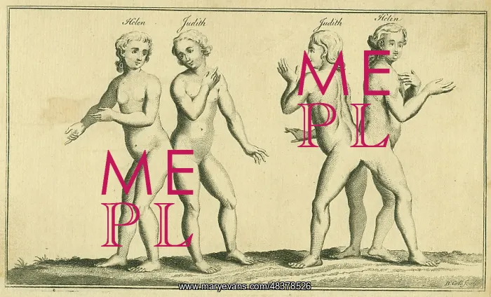 : Siamese or conjoined twins. Helen and Judith : Siamese or conjoined twins. Helen and Judith