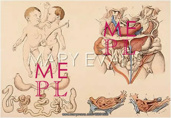 : Siamese twins in anatomical drawing : Siamese twins in anatomical drawing