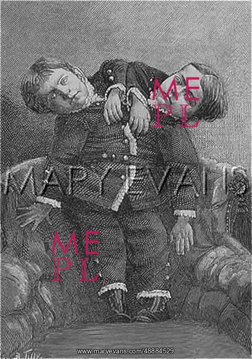 : Siamese twins from Italy : Siamese twins from Italy
