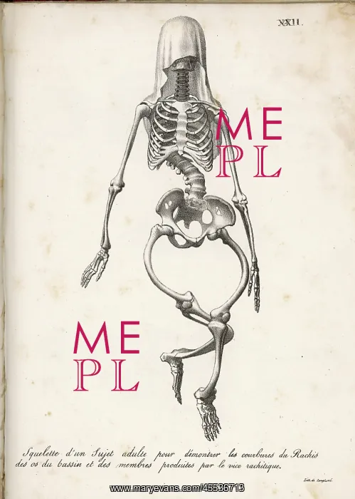 : Skeleton of Rickets : Skeleton of Rickets