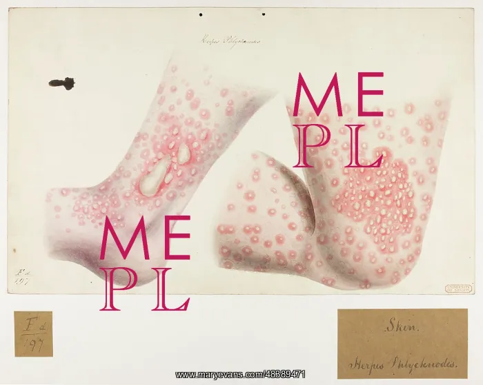 : Skin: Herpes, Phlyctanodes : Skin: Herpes, Phlyctanodes