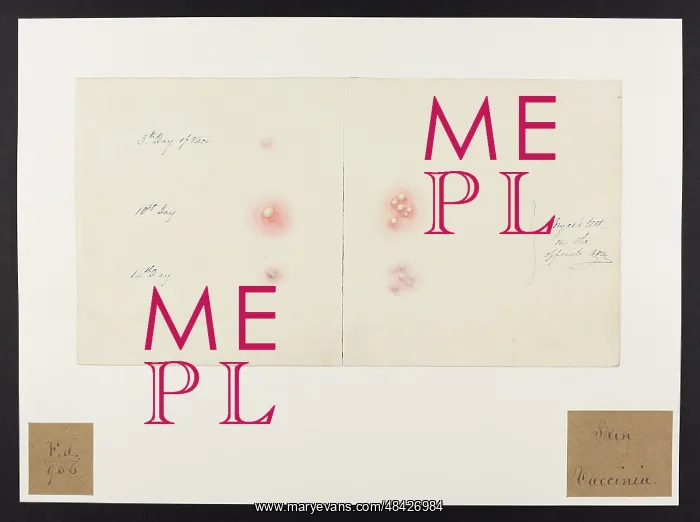 : Skin : Vaccinia : Skin : Vaccinia