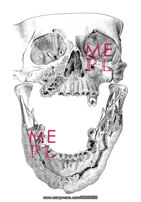 : Skull with Phossy Jaw, Matchmakers Disease : Skull with Phossy Jaw, Matchmakers Disease