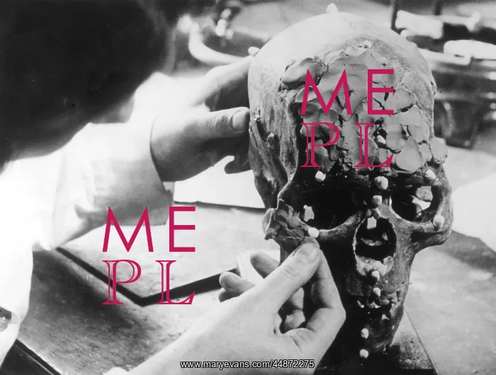 : SKULL RECONSTRUCTION : SKULL RECONSTRUCTION