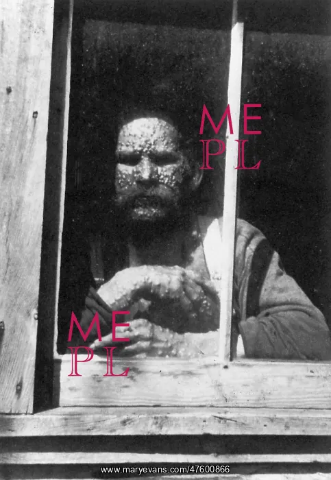: Smallpox. Man with Smallpox in isolation, 1890 : Smallpox. Man with Smallpox in isolation, 1890