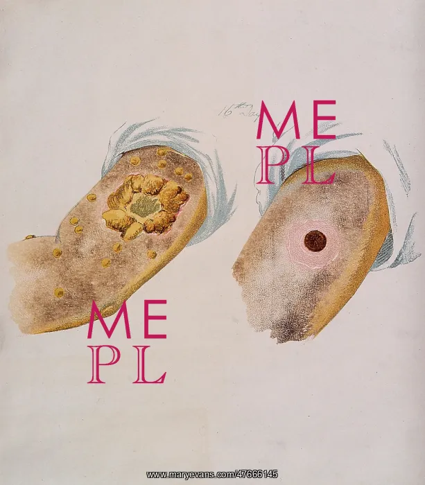 : Smallpox and Cowpox Pustules, Day 16, 1896 : Smallpox and Cowpox Pustules, Day 16, 1896
