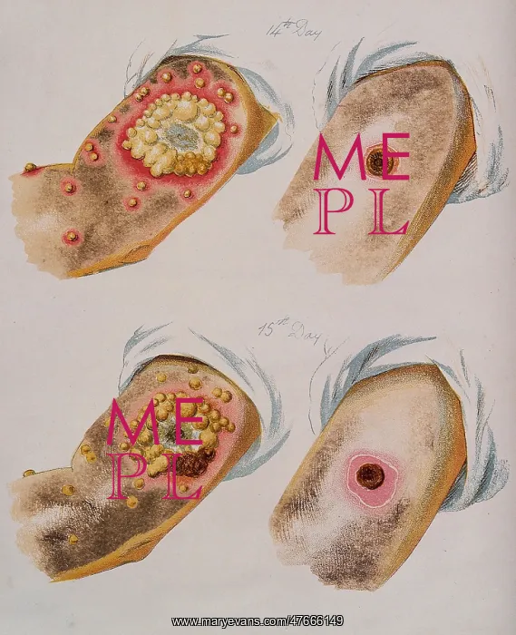 : Smallpox and Cowpox Pustules, Days 14 and 15, 1896 : Smallpox and Cowpox Pustules, Days 14 and 15, 1896