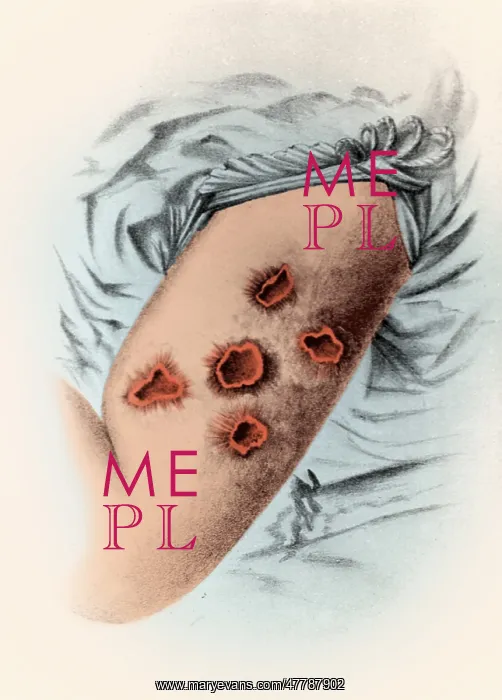 : Smallpox Pustules, 1898 : Smallpox Pustules, 1898