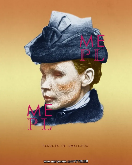 : Smallpox Victim : Smallpox Victim