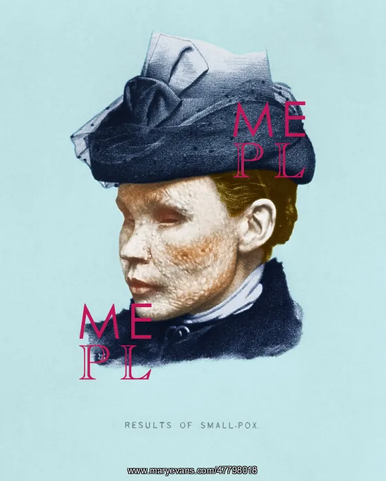 : Smallpox Victim : Smallpox Victim