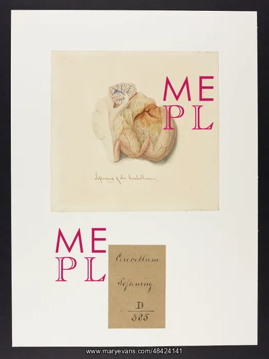 : Softening of the Cerebellum : Softening of the Cerebellum