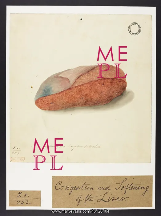 : Softening and Congestion of the Liver : Softening and Congestion of the Liver