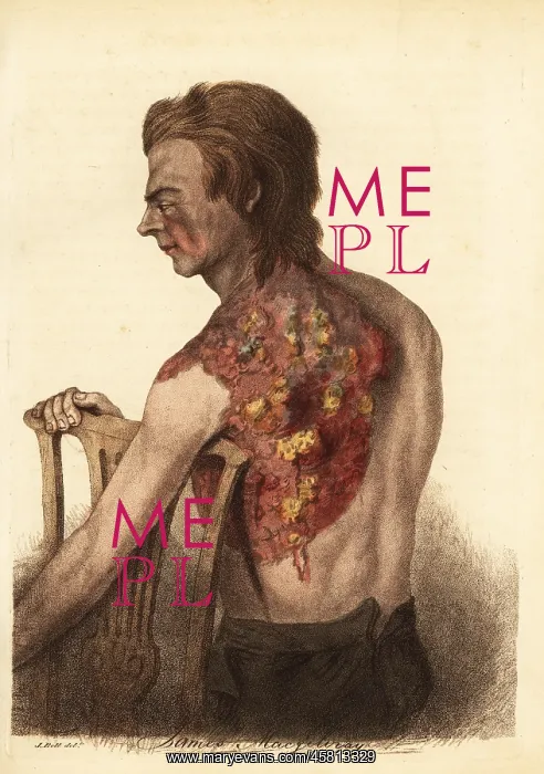 : Soldier with an abscess from a gunshot wound to the shoulder : Soldier with an abscess from a gunshot wound to the shoulder