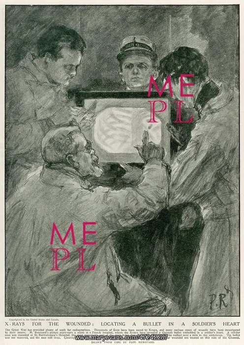 : SOLDIER X-RAYED 1915 : SOLDIER X-RAYED 1915