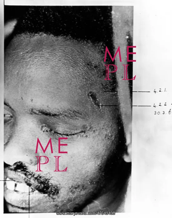 : Steve Biko's injuries : Steve Biko's injuries