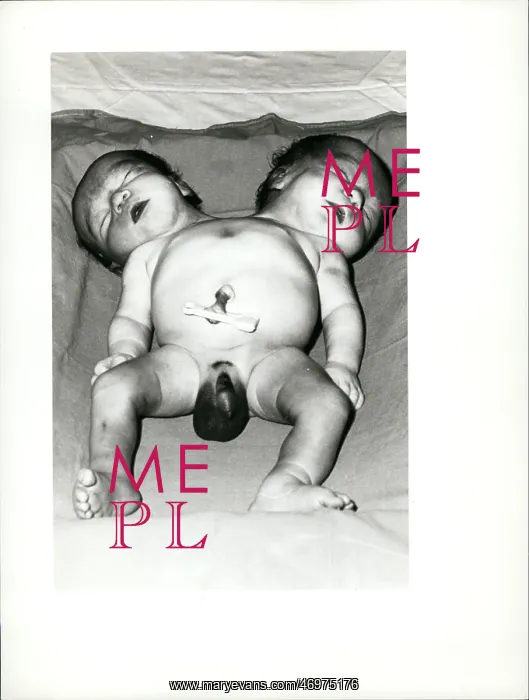 : Stillborn Siamese twins after Caesarean, operation, Portugal : Stillborn Siamese twins after Caesarean, operation, Portugal