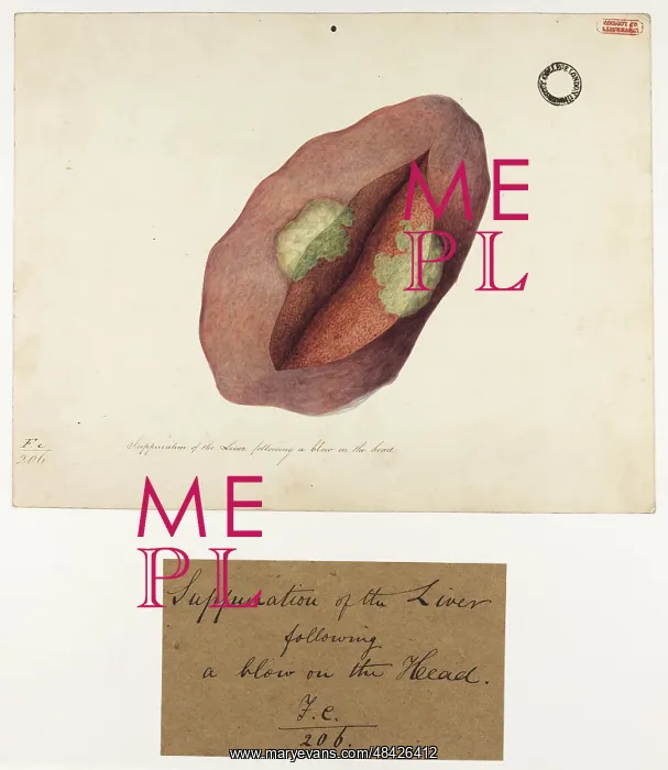 : Suppuration of the Liver : Suppuration of the Liver
