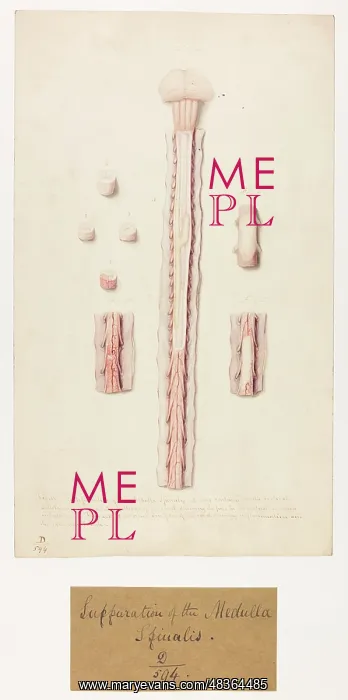: Suppuration of the Medulla Spinalis : Suppuration of the Medulla Spinalis