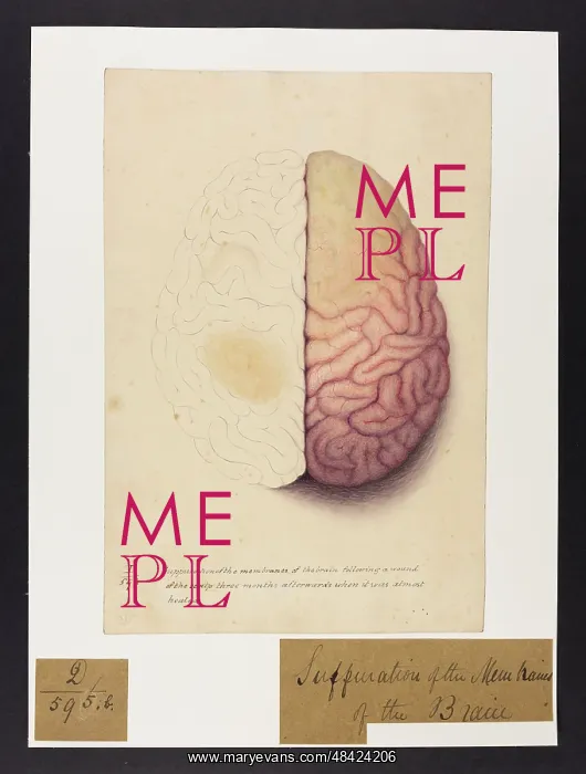  : Suppuration of the Membranes of the Brain