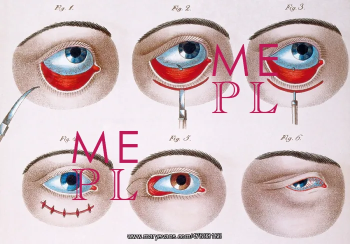 : Surgery to Correct Lazy Lower Eyelid, c, 1830 : Surgery to Correct Lazy Lower Eyelid, c, 1830