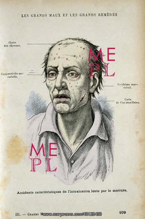 : Symptoms characteristic of long-term mercury poisoning : Symptoms characteristic of long-term mercury poisoning