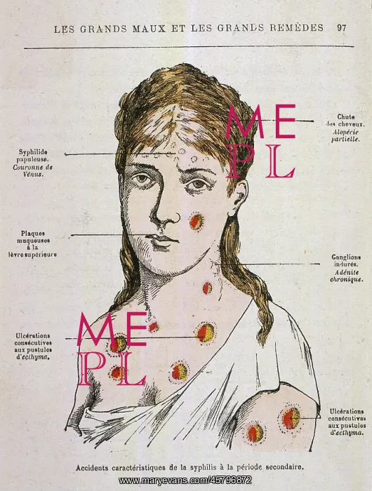 : SYPHILIS / 1883 : SYPHILIS / 1883