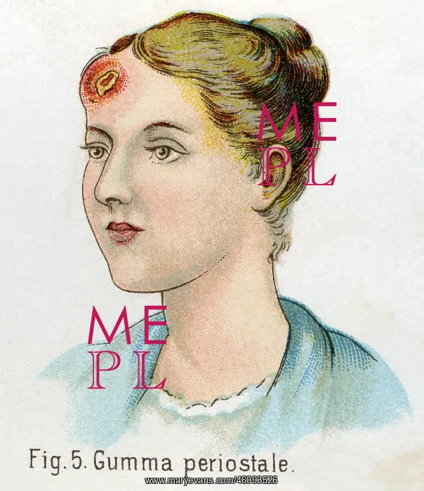 : Syphilis, Gumma periostale, 1902 : Syphilis, Gumma periostale, 1902