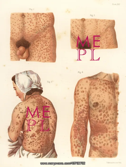 : Syphilis symptoms on the body : Syphilis symptoms on the body