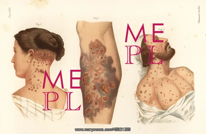 : Syphilis symptoms on the body : Syphilis symptoms on the body